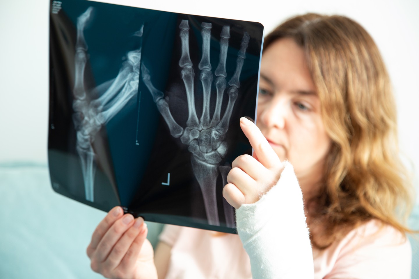 woman with broken arm is looking at her x ray 2023 11 27 05 17 56 utc 1